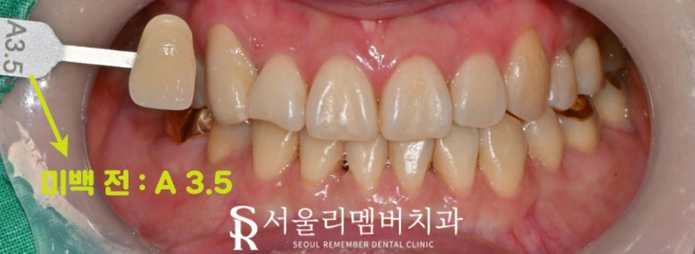 신림 치과 에서 전문가 치아 미백으로 안전하게! 관련 이미지 1