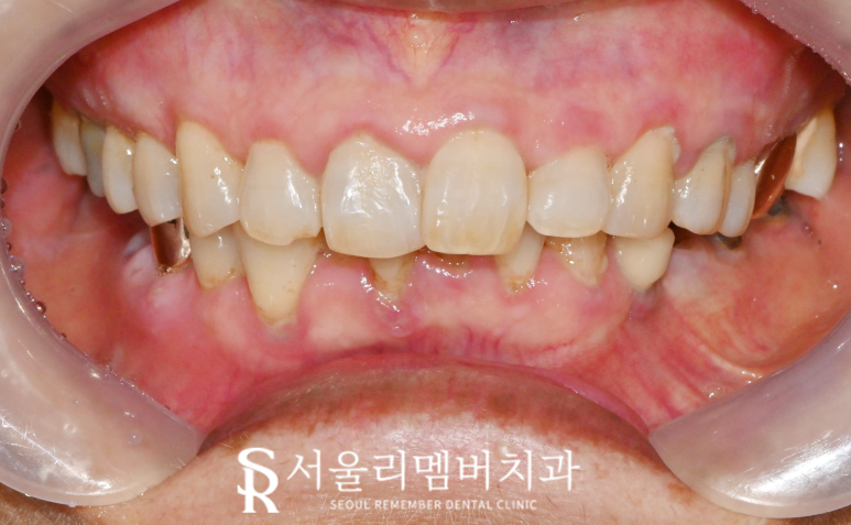 봉천동 치과 상실된 치아 방치하면 안 되는 이유 (feat.임플란트 브릿지 보철치료) 관련 이미지 4