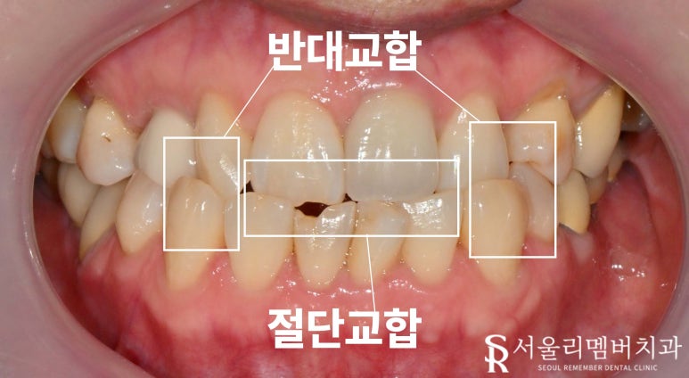 중년 치열 틀어짐 및 파절과 변색, 봉천동 치과 치아교정 대신 심미보철 치료 (임플란트 크라운 라미네이트 복합 증례) 관련 이미지 2
