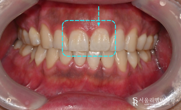 When a Front Tooth Breaks: Bongcheon-dong Dental Clinic Explains Resin Treatment image 2