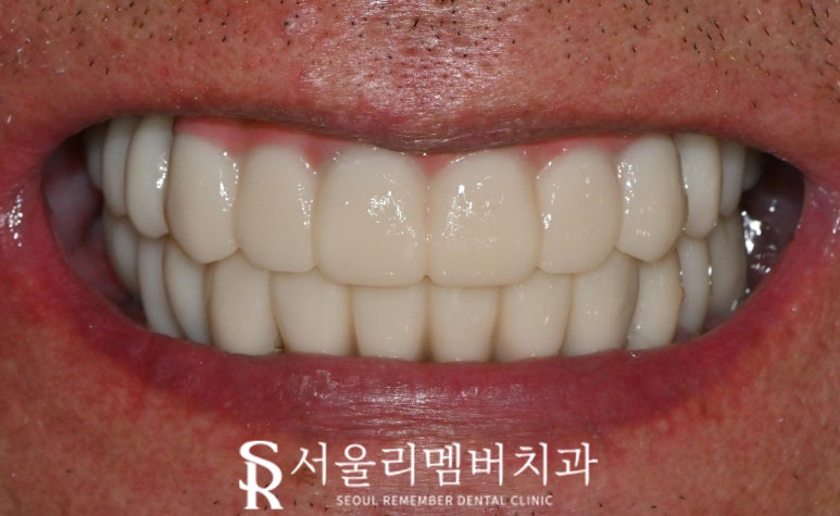 서울대입구역 치과 에서 안전하고 신속 정확하게 발치 후 전악 임플란트 식립한 케이스 관련 이미지 8