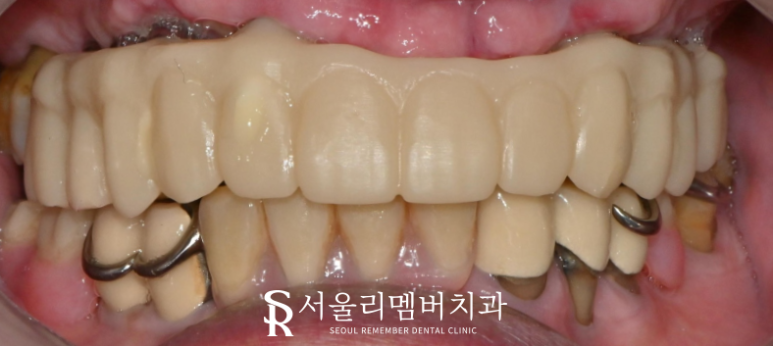 서울대입구역 치과 나에게 맞는 보철은 틀니? 임플란트? 관련 이미지 7