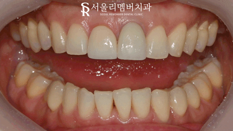 봉천동 치과 위 앞니 크라운 마음에 안 든다면? 상악 중절치 보철 재제작 재치료 과정 관련 이미지 1
