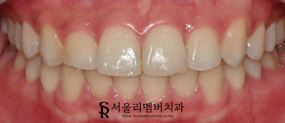 낙성대역 치과 앞니가 깨졌는데 당일 치료 가능할까요? 관련 이미지 4