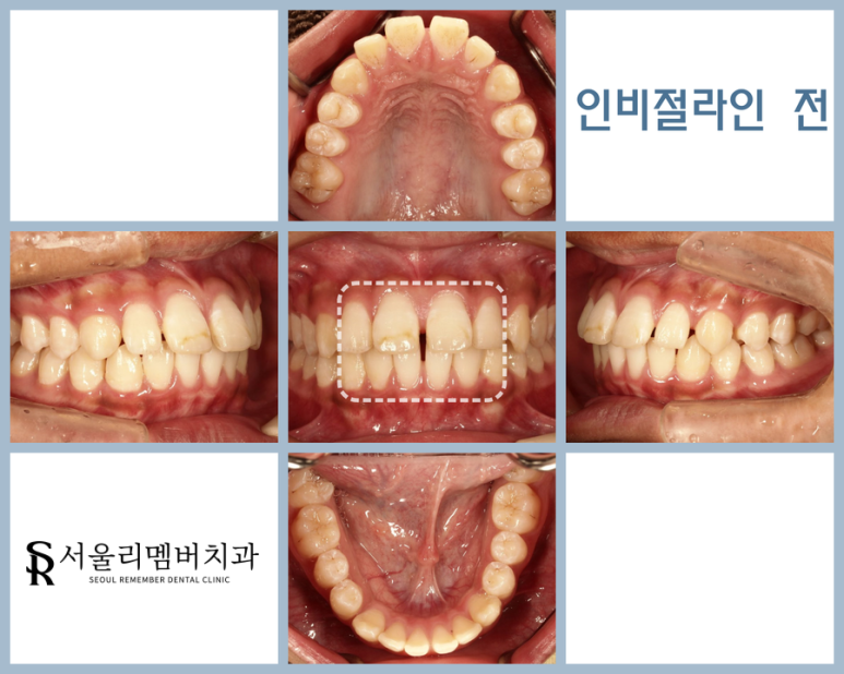 벌어지고 삐뚠 치아 교정 전 관련 이미지 1