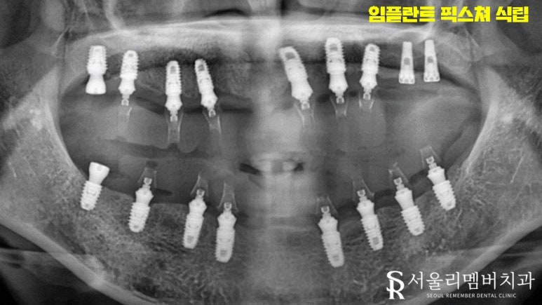 금방이라도 빠져버릴 것 같은 치아들, 전체임플란트 식립으로 개선했던 이야기. 이수역 서울 리멤버 치과 관련 이미지 5