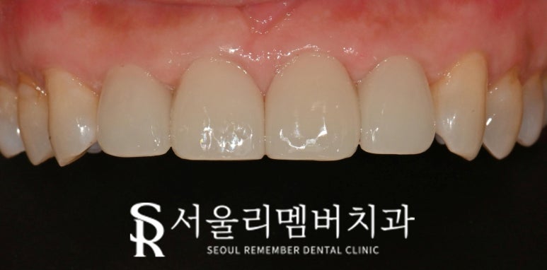 Restore a Natural, Even Smile with No-Prep Realnate! Laminate Veneers for Front Teeth at a Seoul National University Entrance Station Dental Clinic image 2
