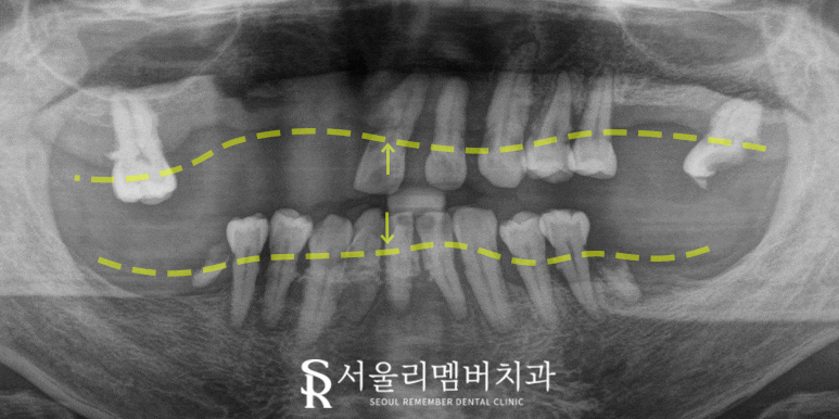 "도저히 음식을 먹지 못해요" 봉천역 치과 수면 임플란트 치료 사례 관련 이미지 4