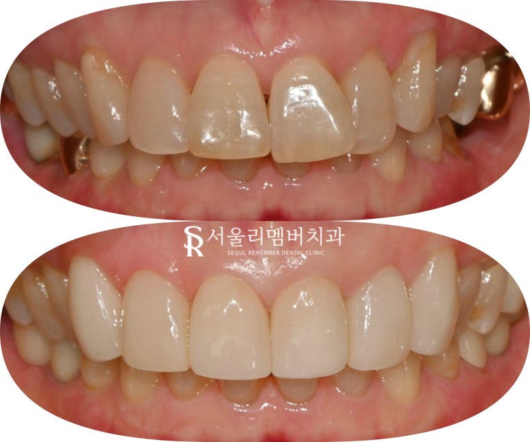 앞니 크라운, 무삭제 리얼네이트로 치열 및 톤 개선 신림 치과 최소삭제 라미네이트 당일 치료 관련 이미지 4