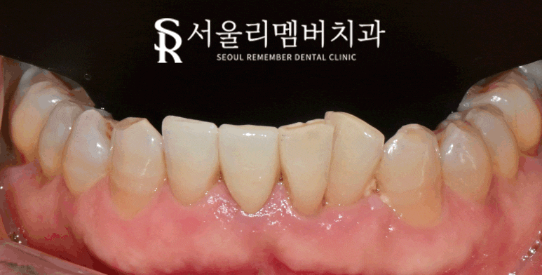 신림 치과 오래된 아래 앞니 PFM 크라운 치경부 금속 비침과 치근단 병소로 신경치료 후 지르코니아 심미보철 수복 관련 이미지 4