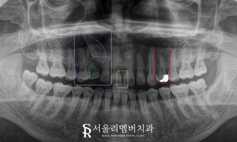 서울대입구 치과 에서 앞니 벌어짐, 변색, 부러지고 통증 있는 치아 레진과 크라운으로 심미 치료 해드린 사례 관련 이미지 2
