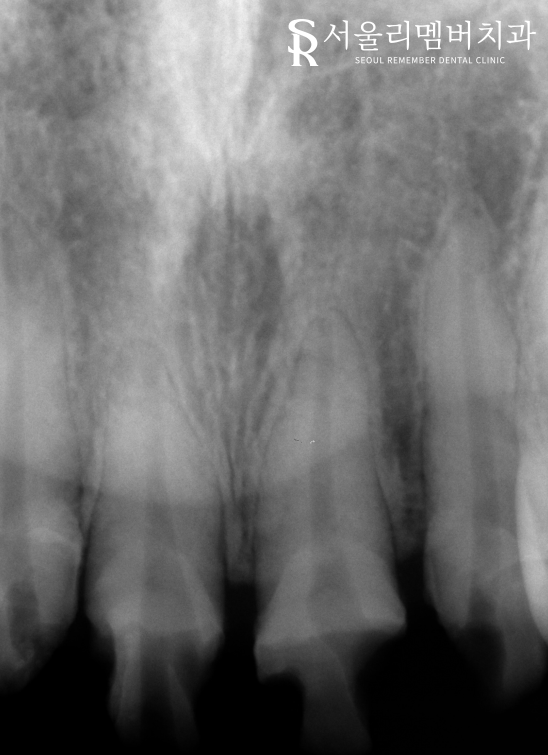 전치부 신경치료, 크라운까지 확실하게 씌워야 되는 이유는? 서울대입구역치과 관련 이미지 2