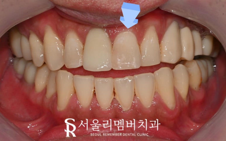 봉천동 치과 앞니 파절 응급 상황에서도 당일 치료 가능한 레진 수복 (해외 거주자도 가능) 관련 이미지 2