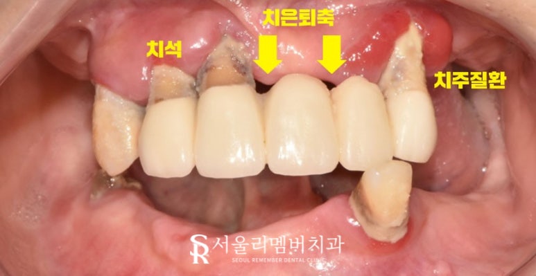 텅텅 여기저기 빠져버린 치아들, 이젠 음식을 씹을 수도 없어요.. 어떡하죠? 서울대입구역 리멤버 치과 관련 이미지 4