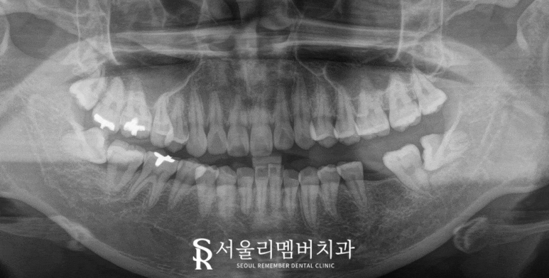 상실된 작은 어금니와 사랑니가 있을 때, 사당 치과 임플란트 및 안전한 발치 과정은? 관련 이미지 1