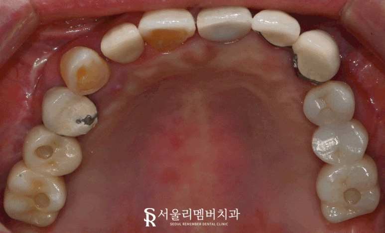 잇몸뼈 소실 다수의 치아 서울대입구역 치과 에서 전체 임플란트 브릿지 수술 진행 관련 이미지 2