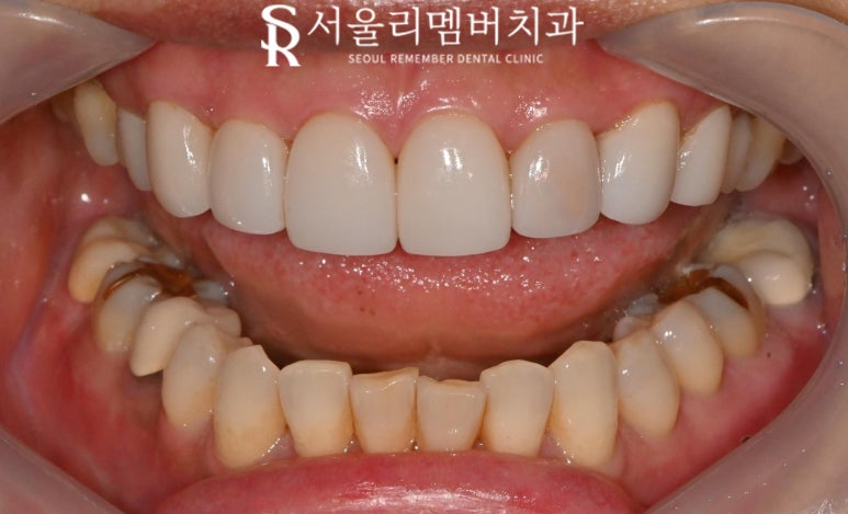 기존 라미네이트 보철 변색 및 송곳니 파절 안쪽으로 이차 우식 생겼을 때 신림역 치과 수면으로 충치치료 리얼네이트 당일 진료 가능할까 관련 이미지 2