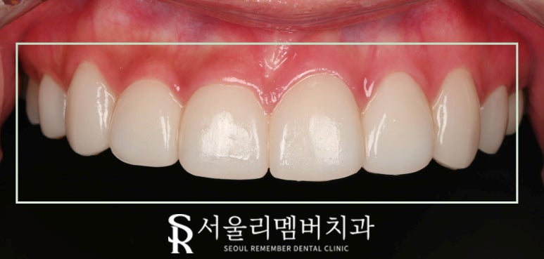 사당역 치과 리얼네이트 심미보철 라미네이트로 누렇고 약한 앞니부터 작은 어금니까지 변화 관련 이미지 6
