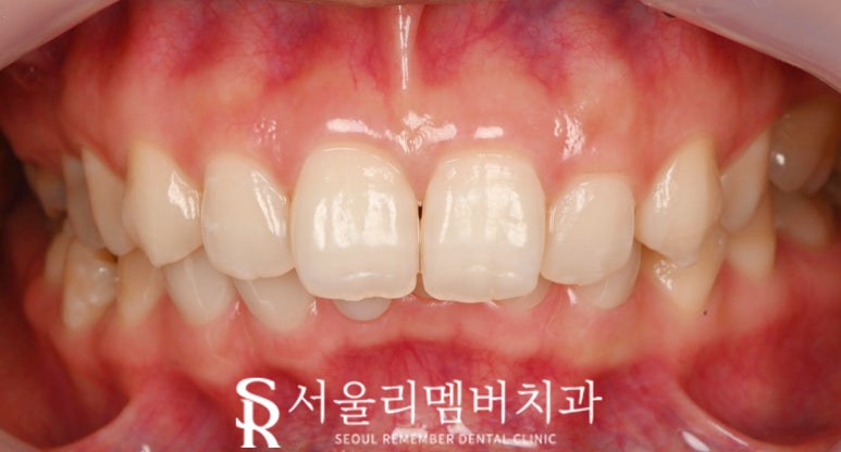 사당 치과 아래 앞니 만기 잔존 유치 크라운과 리얼네이트 동시에 심미 보철 치료 관련 이미지 7