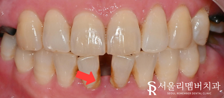 보라매역 치과 신경치료 및 크라운으로 기능과 외관 되살리기. 관련 이미지 3
