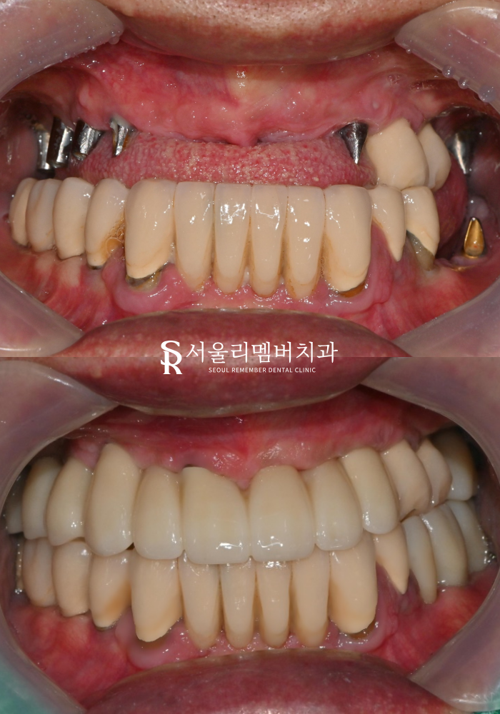 디지털 임플란트 로 신림역 치과 에서 다수의 빈자리 식립 설명 드립니다. 관련 이미지 4
