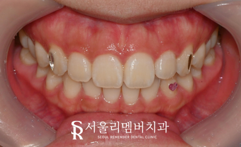 MZ 세대 인기 만점 투스잼(Tooth Gem), 어떻게 붙이고 어떻게 제거할까요? 서울대입구치과 관련 이미지 1