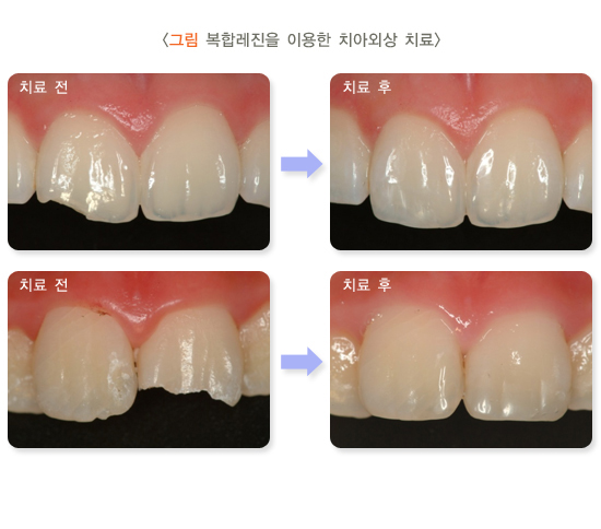 "빠각" 소리와 함께 앞니 절단연 파절 되었다면? 서울대입구역 치과 레진 당일 치료 관련 이미지 3