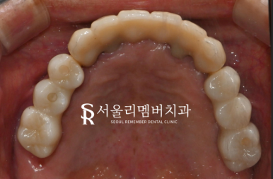 서울대입구역치과 수면마취를 사용한 전체 임플란트 식립 과정 관련 이미지 7