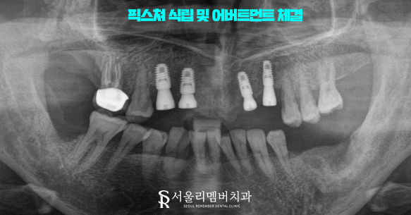 신림역 치과 임플란트 식립 시 어떤 것을 우선적으로 고려하는 것이 좋을까? 관련 이미지 3