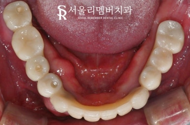 고난도 수술, 서울대입구역 임플란트 치과 에서 치료해야 되는 이유는? 관련 이미지 5