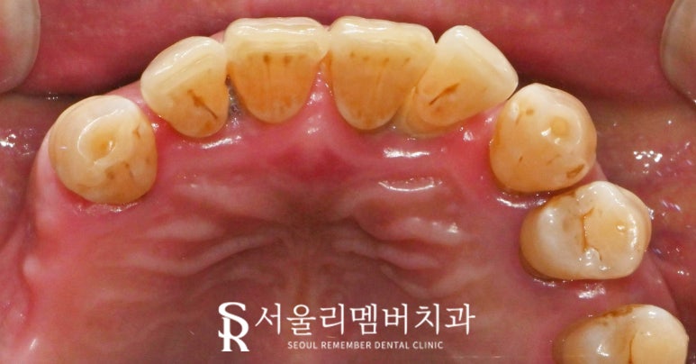 서울대입구역 치과 "부분틀니에서 임플란트로" 바꿔서 전악 개선해 드린 증례 관련 이미지 5