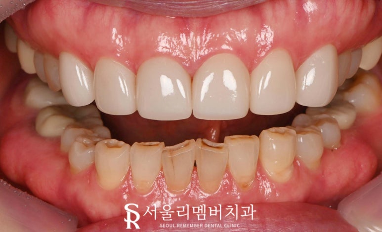 상도동 치과 누렇게 보이는 앞니 6전치 심미보철 라미 리얼네이트로 밝고 자연스럽게 개선한 사례 관련 이미지 4