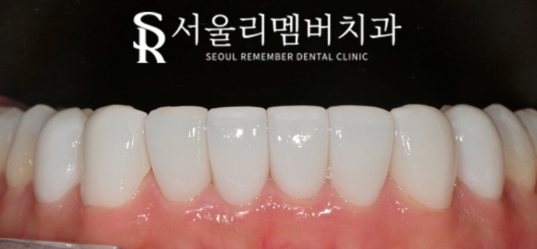 A Surge in Instagram DM Reservation Inquiries at Seoul National Univ. Entrance Station Dental Clinic: A Complete Rundown of Questions About Real Laminate image 8
