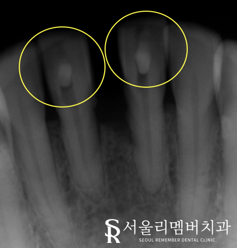 보라매역 치과 신경치료 및 크라운으로 기능과 외관 되살리기. 관련 이미지 4