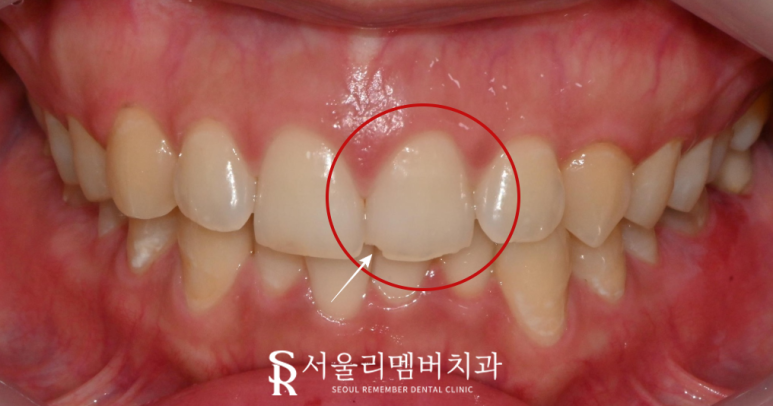 서울대입구역 치과 앞니 깨짐은 레진 당일 충전으로 심미 수복 치료하면 고민 해결 관련 이미지 1