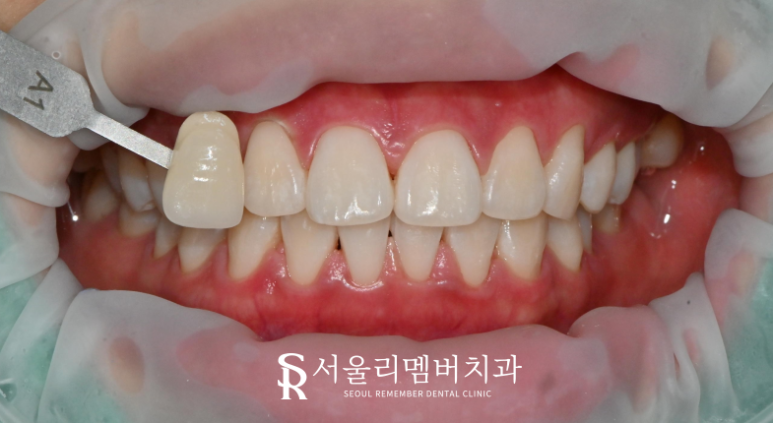 서울대입구역치과 치아미백으로 누런 치아를 얼마나 개선할 수 있을까요? 관련 이미지 2
