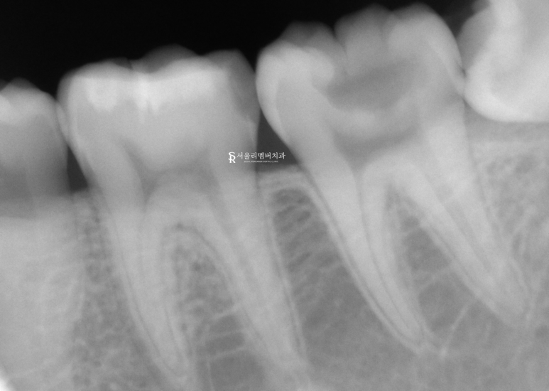 서울대입구역 치과 근관치료 증례 관련 이미지 2