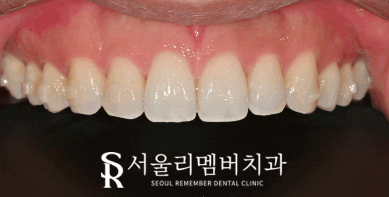 A Surge in Instagram DM Reservation Inquiries at Seoul National Univ. Entrance Station Dental Clinic: A Complete Rundown of Questions About Real Laminate image 3