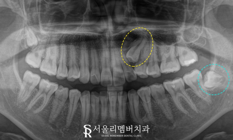 서울대입구 치과 에서 숨어있는 견치 와 매복 사랑니 까지 한 번에 안 아프게 뽑아드렸습니다. 관련 이미지 1