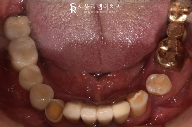 전에 씌워놨던 크라운에서 통증이 느껴져요.. 도대체 왜 그런 거죠? 서울대입구역 서울 리멤버 치과 관련 이미지 3