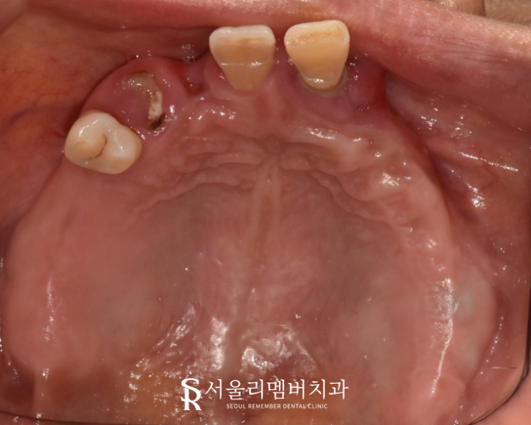금방이라도 빠져버릴 것 같은 치아들, 전체임플란트 식립으로 개선했던 이야기. 이수역 서울 리멤버 치과 관련 이미지 2