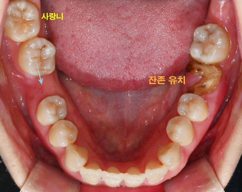 선천적 영구치 결손으로 남아있는 만기 잔존 유치, 서울대입구역 교정 치과 에서 투명 인비절라인 & 임플란트 케이스 관련 이미지 3