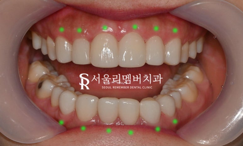 낙성대 치과 앞니 틀어짐 하악 전치 측절치 결손 라미네이트로 공간 닫기 성공 관련 이미지 6