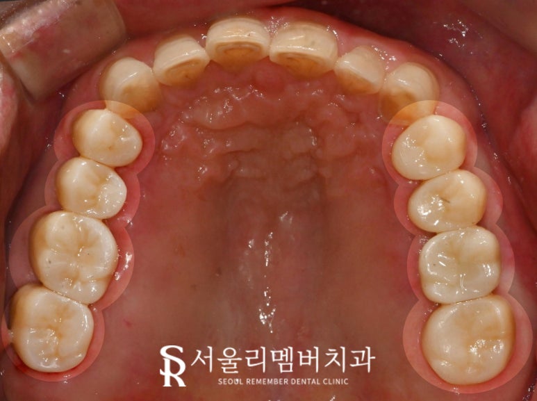 서울대입구역 치과 어금니 상실로 무너진 수직 고경과 과개 교합, 신경치료 크라운과 임플란트로 개선할 수 있다면 관련 이미지 5