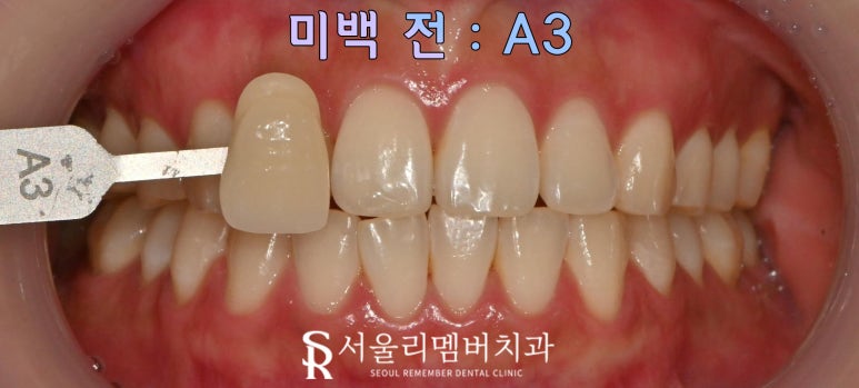 봉천동 치과 의사가 알려주는 치아미백 방법, 효능, 원리, 주의 사항 관련 이미지 1