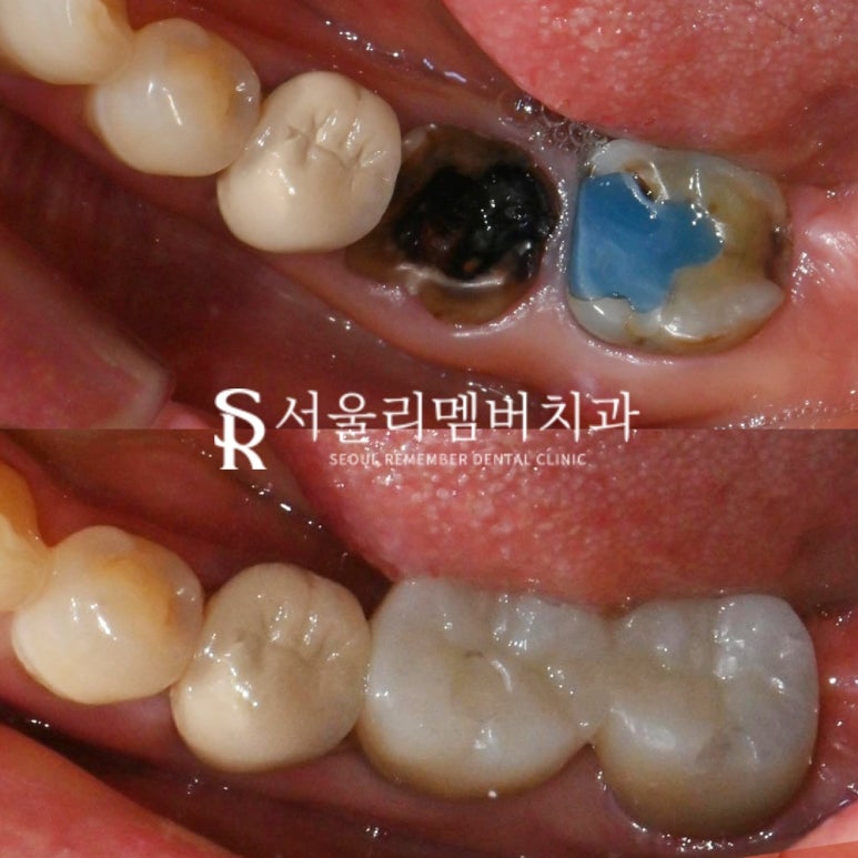 살리려던 어금니, 신경치료 시도 후 결국 임플란트로 복구한 보라매 치과 치료 사례 관련 이미지 7