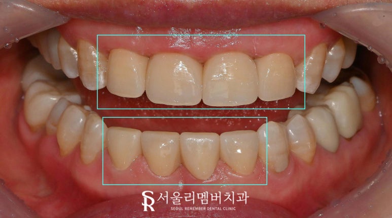 위아래 앞니 벌어짐으로 상하악 전치부 크라운 치료하는 과정은? 서울대입구 치과 관련 이미지 3