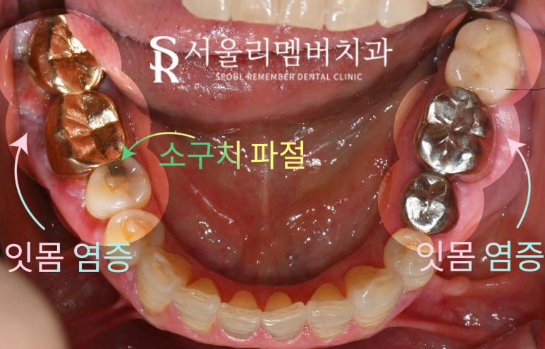 잇몸뼈 녹아버린 치아, 발치 후 그다음은? 사당역 치과 임플란트 관련 이미지 2
