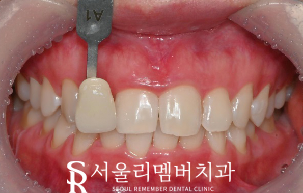 "하얀 치아를 갖고 싶어요!" 신대방 치과 에서 치아미백 받아보세요. 관련 이미지 3