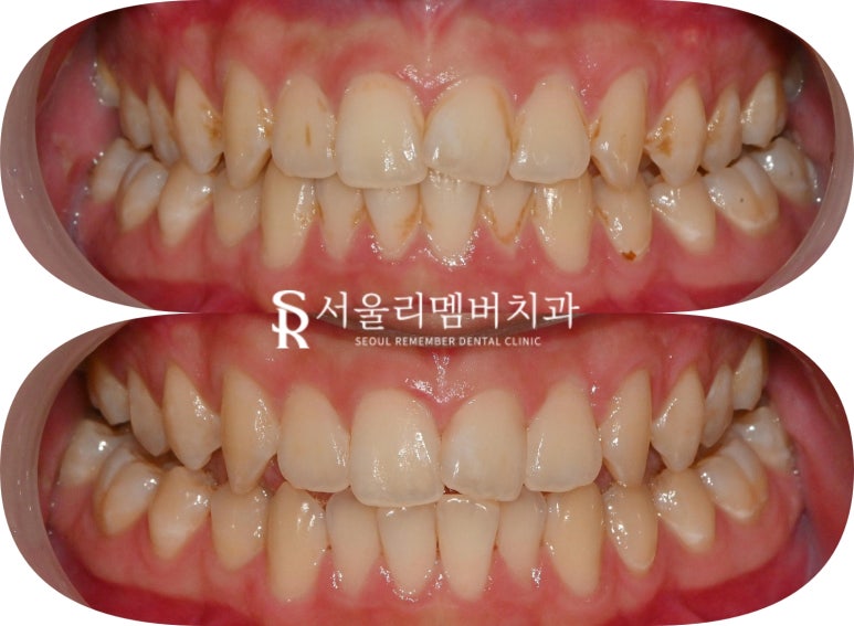 서울대입구 치과 연 1회 보험 스케일링으로 착색 제거 및 잇몸 건강 지키기 관련 이미지 3